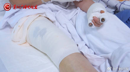 皇冠信用网注册
_女子水中捡漂亮石头装裤兜里被烧伤皇冠信用网注册
，医生：“石头”初步判定是磷